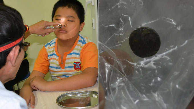 Doctors remove battery stuck in boy’s nose for 5 yrs