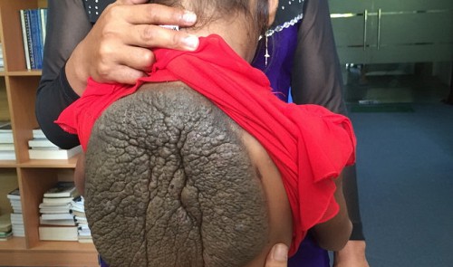 Vietnamese girl has 1kg turtle-shell-like mole removed from back