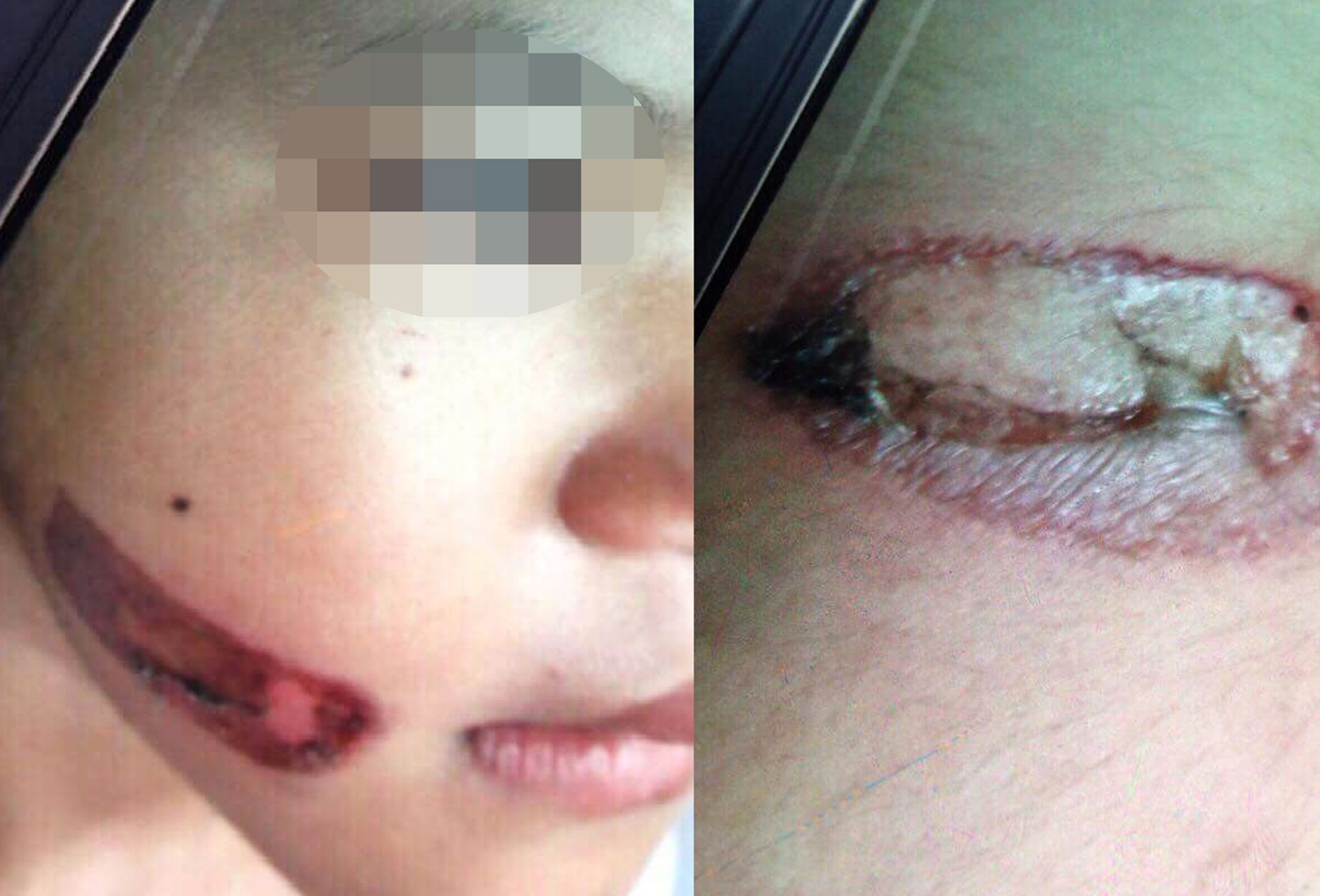 ​7-yr-old Vietnamese girl tortured with heated iron by father, stepmother