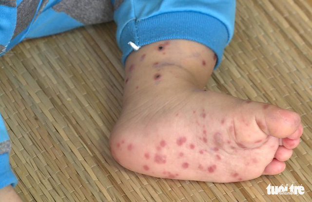 A child suffering from hand, foot, mouth disease in Tien Giang Province, southern Vietnam. Photo: Tuoi Tre
