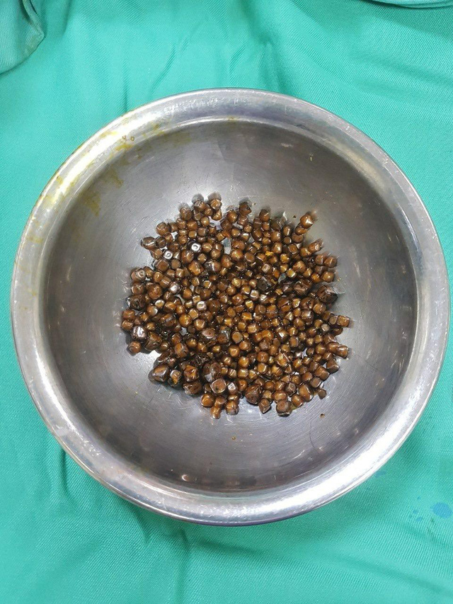 Doctors find 400 gallstones in Vietnamese woman’s gallbladder | Tuoi ...