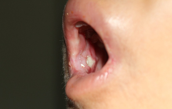 An open sore inside the patient’s mouth caused by lichen planus. Photo: Tuoi Tre