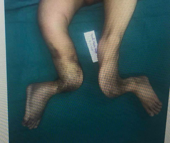 The severely deformed, root-like legs of Nguyen Manh Hung pre-surgery is seen in this photo provided by the hospital.