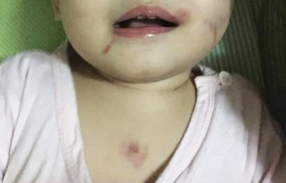 A 14-month-old girl is covered in bruises after her first day of preschool in Hai Phong City, Vietnam. Photo: Nguyen Tan / Tuoi Tre