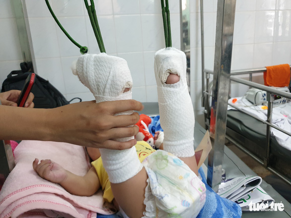 Four-month-old C.M.K. lies on a hospital bed undergoing traction at the Children’s Hospital 2 in District 1, Ho Chi Minh City. Photo: Minh Hoa / Tuoi Tre