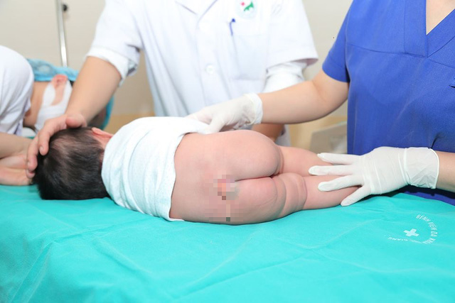 Vietnamese girl born with human tail undergoes removal surgery