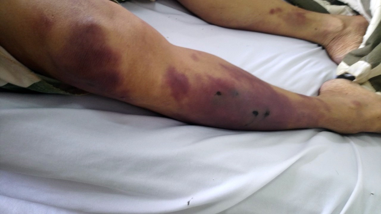 The body of Nguyen Q. L., who was found dead inside a cell at a custody suite of a police station in Chau Duc District, Ba Ria – Vung Tau Province, Vietnam on May 8, 2020, is full of bruises in this photo provided by the victim’s family.