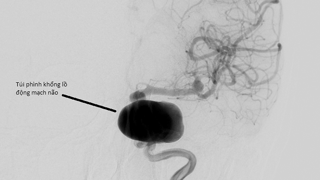 An aneurysm balloon in brain artery is shown in a supplied file photo achieved through medical imaging.