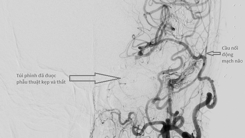 Blood vessels are inserted and an aneurysm balloon is nullified using the artery bypass technique in a supplied file photo of the brain achieved through medical imaging.