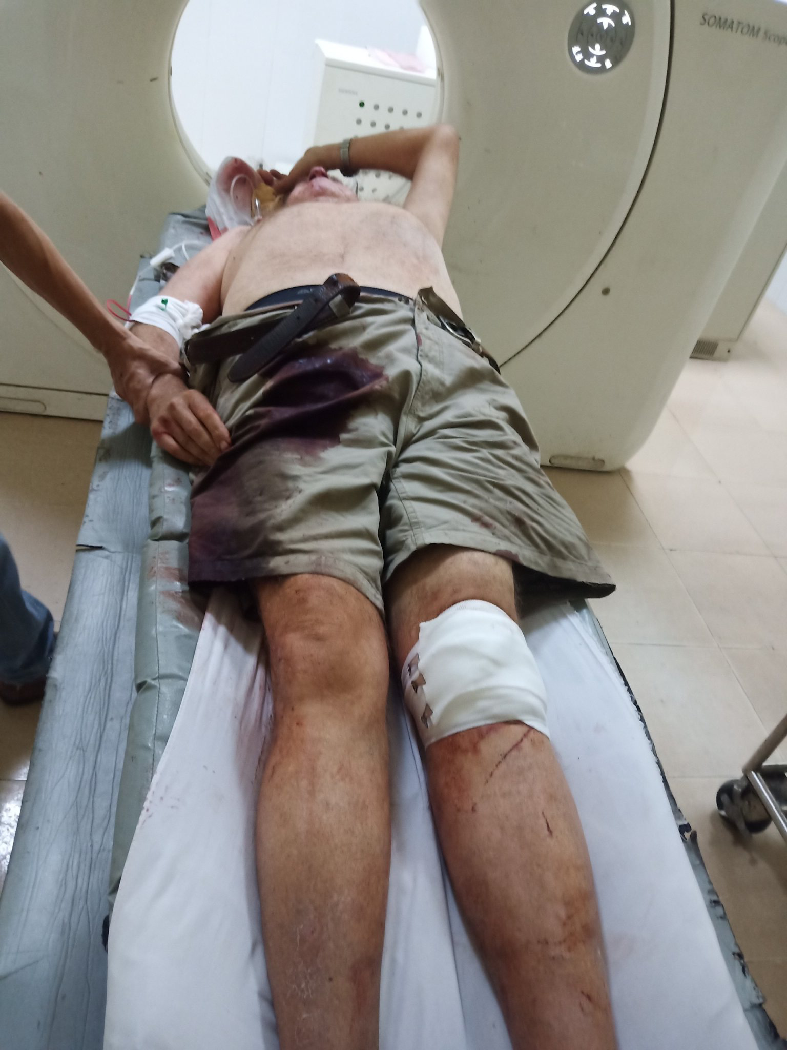 British citizen Stuart Surtess undergoes a CT scan at Quang Ngai General Hospital following a road accident in Quang Ngai Province, Vietnam. Photo: M.D.