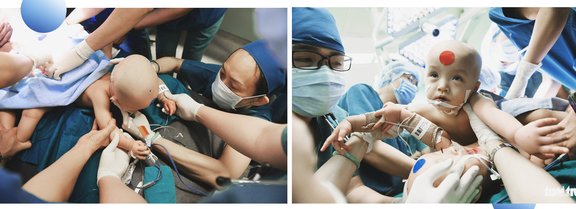 The conjoined twins are given anesthesia at HCM City Pediatrics Hospital.