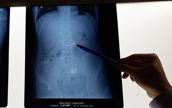 Hanoi doctors remove earbud from 15-yo patient’s stomach