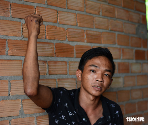 Nguyen Van Chien at his home in Village 1, Suoi Kiet Commune, Tanh Linh District, Binh Thuan Province, Vietnam, after surviving the road crash. Photo: Duc Trong / Tuoi Tre