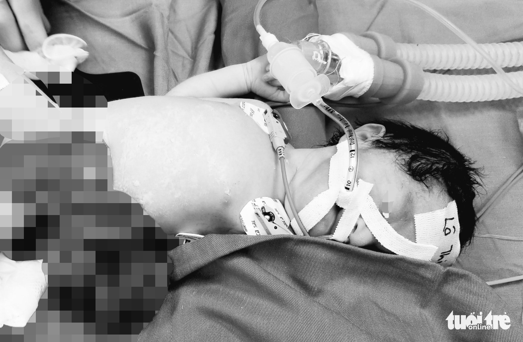 Doctors save newborn with organs outside of belly in Vietnam