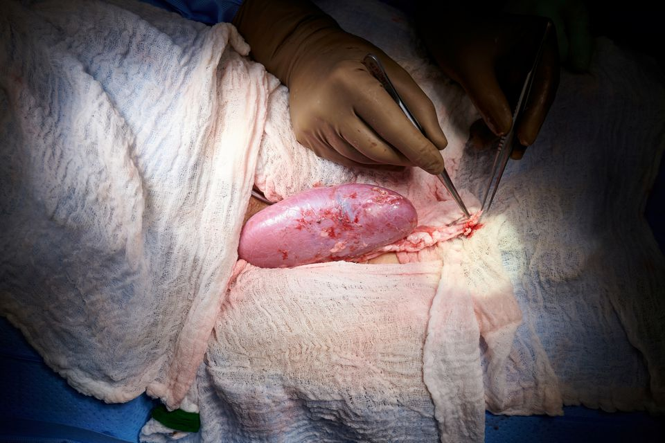 A genetically engineered pig kidney appears healthy during a transplant operation at NYU Langone in New York, U.S., in this undated handout photo. Photo: Joe Carrotta for NYU Langone Health/Handout via Reuters