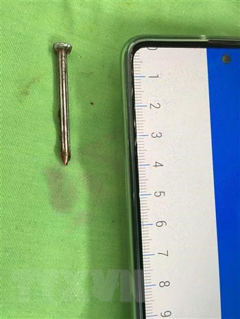 A nail which is four centimeters in length and five millimeters in diameter was removed from the skull of a patient suffering from depression. Photo: Vietnam News Agency