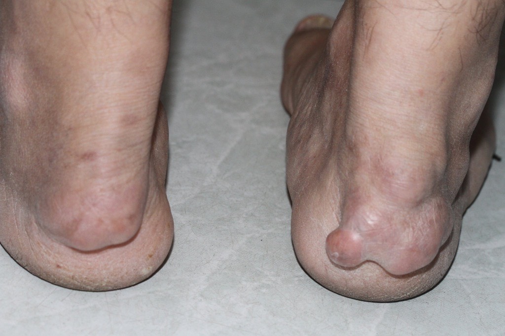 This supplied photo shows lumps under the heel tendons.