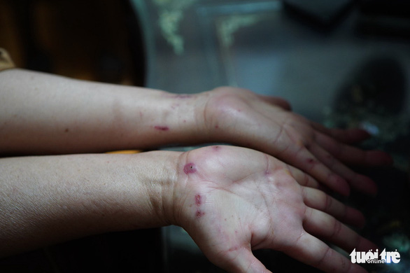 Nguyen Thi Bich Lien shows wounds on her arms at her house in Nam Tu Liem District, Hanoi, May 4, 2022. Photo: Thanh Chung / Tuoi Tre