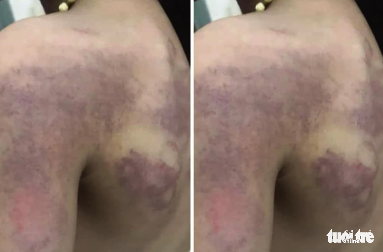 Vietnamese teacher suspended for allegedly causing bruises on student’s back
