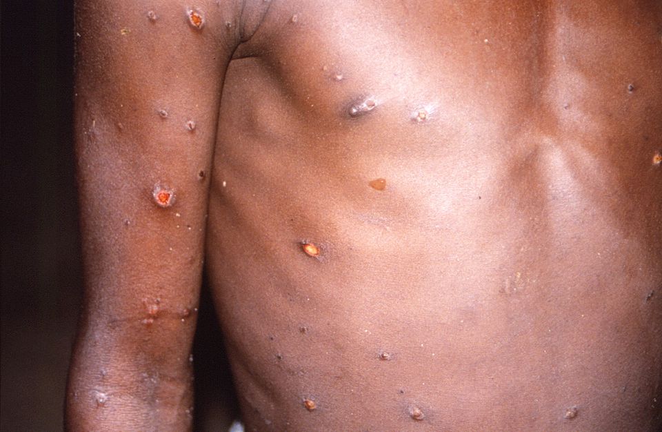 Explainer: Why monkeypox cases are rising in Europe