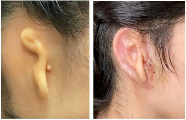 Surgeons transplant 3D ear made of living cells