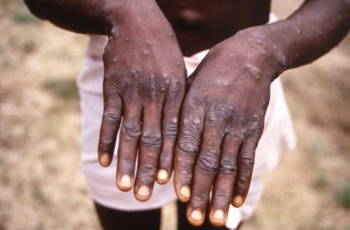 Monkeypox outbreak tops 1,000 cases, WHO warns of 'real' risk