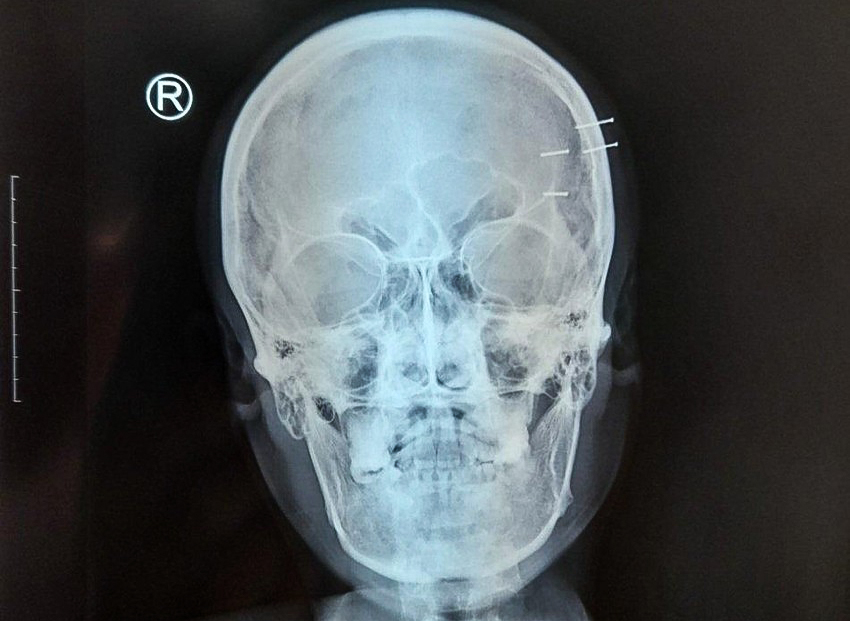 Man hospitalized with nails in head from self-harm in southern Vietnam
