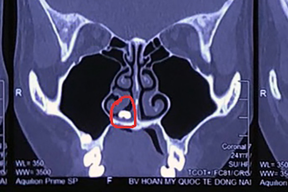 This CT scan shows the extra tooth in the patient’s nasal cavity. Photo: A.B. / Tuoi Tre