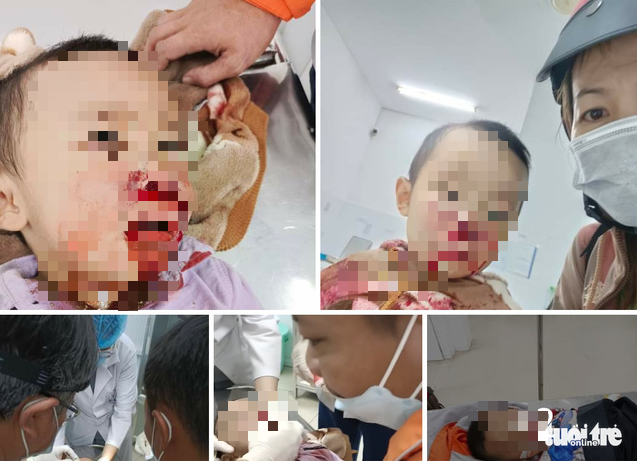 Woman accuses traffic police of breaking 3-year-old son’s nose in southern Vietnam