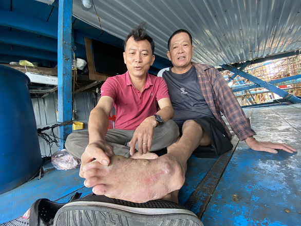 A big scar on his foot caused by a falling pot of boiling rice. Photo: B.D. / Tuoi Tre