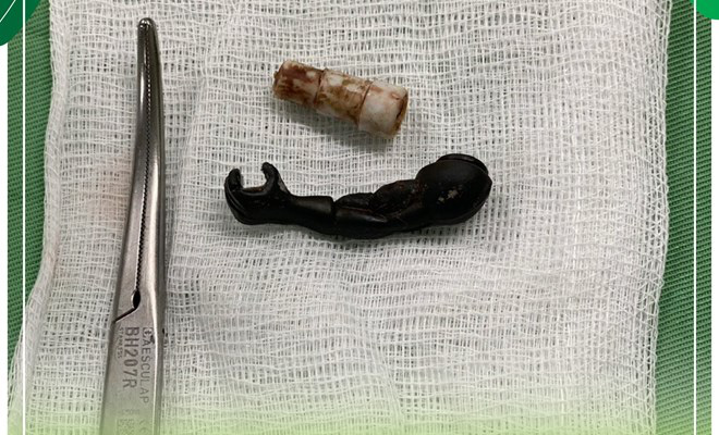 Vietnamese doctors remove toy robot arm from five-year-old girl’s vagina
