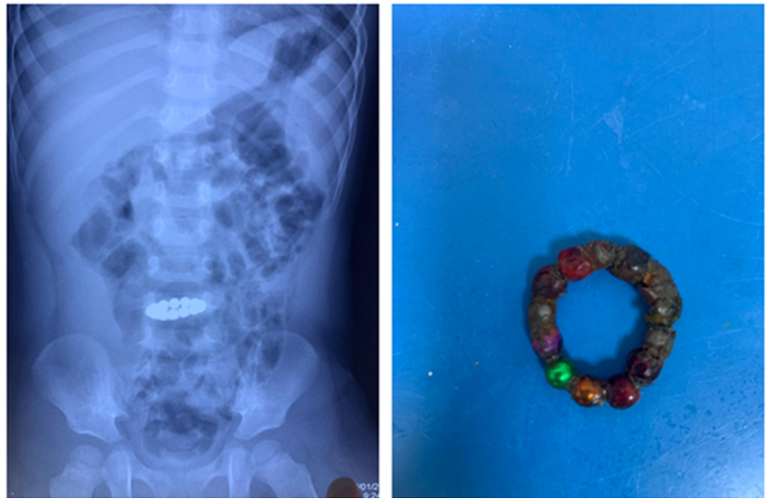 Ho Chi Minh City doctors save toddler with ring of rusted magnet marbles in intestines