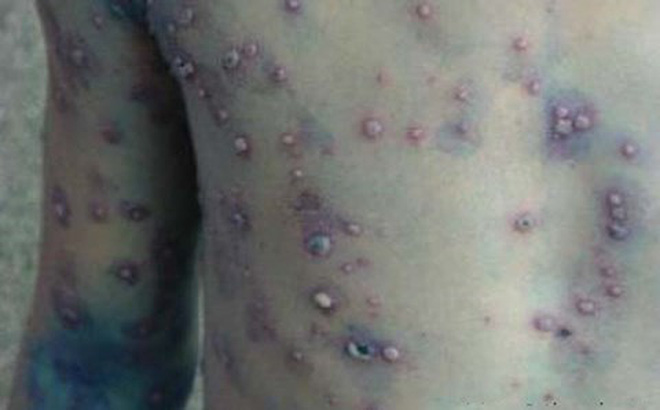 32-year-old Vietnamese man dies of chickenpox