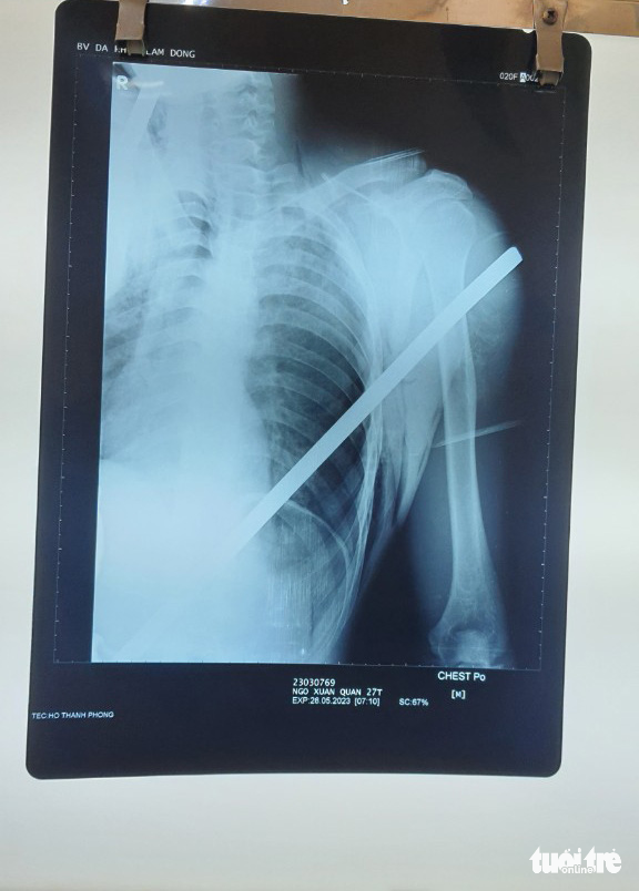 The X-ray result of Ngo Xuan Q. at Lam Dong General Hospital in Lam Dong Province, Vietnam. Photo: V.T. / Tuoi Tre